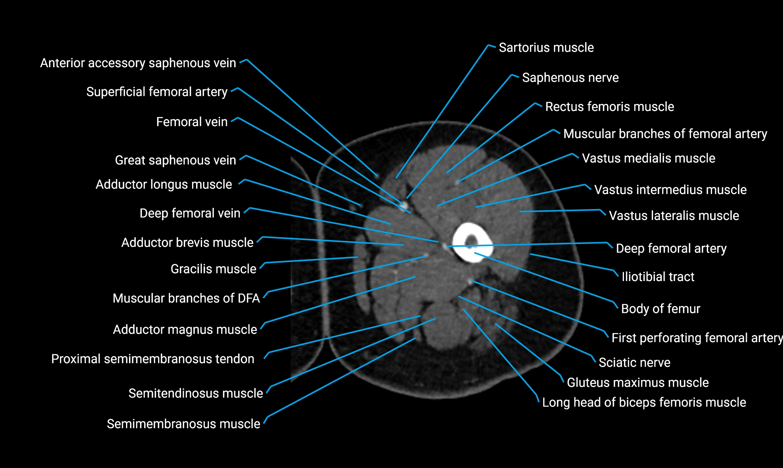 CT lower limb axial cross sectional anatomy labelled image 33 (2).webp